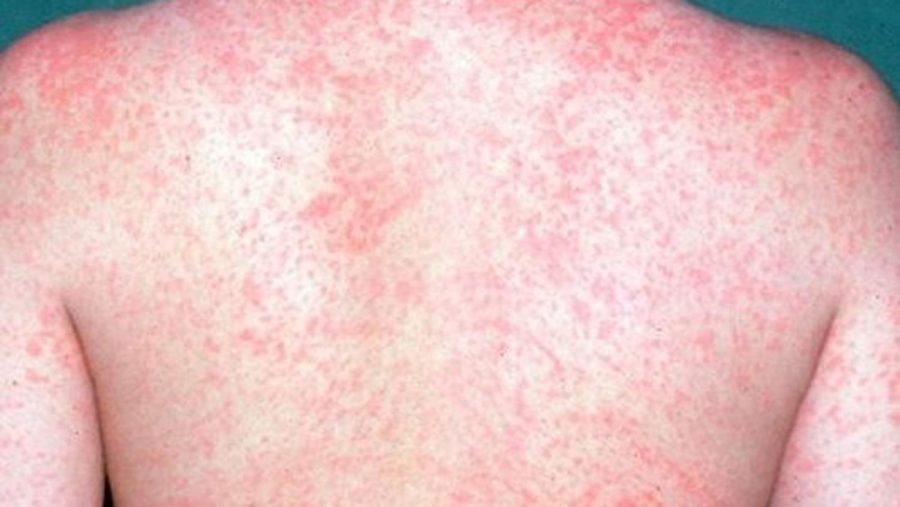 Measles Outbreak reaches its 25 Year Peak in the United States